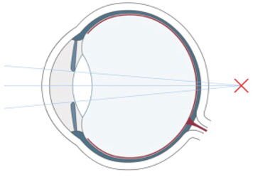 Diagramm eines Auges mit parallelen Lichtstrahlen, die sich hinter der Netzhaut bündeln, was auf eine Hyperopie (Weitsichtigkeit) hinweist, bei der entfernte Objekte klar, nahe Objekte jedoch unscharf erscheinen.