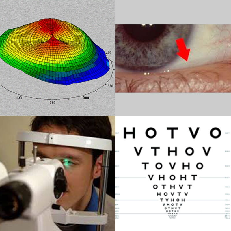 Eine Collage mit einer Karte der Hornhauttopografie, einer Nahaufnahme eines Auges mit einem roten Pfeil, der auf das Auge zeigt, einer Person, die sich einer Augenuntersuchung unterzieht, und einer Augentafel mit kleiner werdenden Buchstaben.