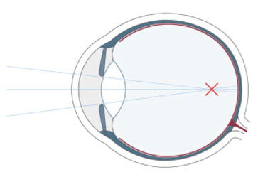 Diagramm eines Augapfels, das zeigt, wie einfallende Lichtstrahlen auf einen Punkt vor der Netzhaut fokussiert werden, was den Zustand der Kurzsichtigkeit veranschaulicht.