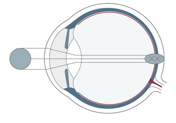 Kurzsichtigkeit (Myopie)