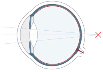Weitsichtigkeit (Hyperopie)