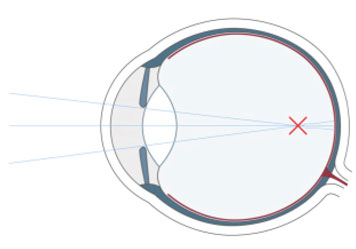 Kurzsichtigkeit (Myopie)